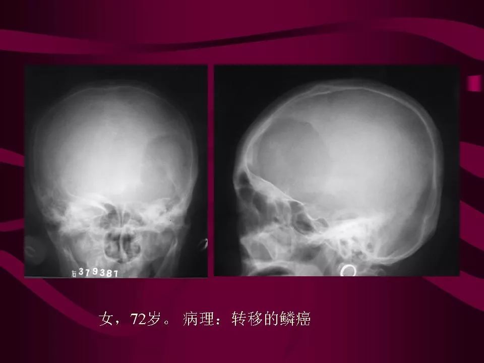 影像PPT - 【PPT】骨转移瘤的影像诊断-39