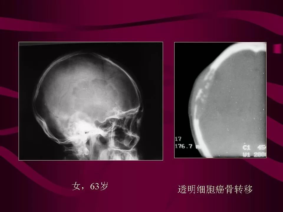 影像PPT - 【PPT】骨转移瘤的影像诊断-38