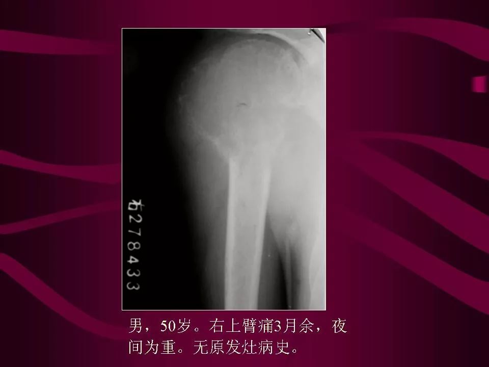 影像PPT - 【PPT】骨转移瘤的影像诊断-40