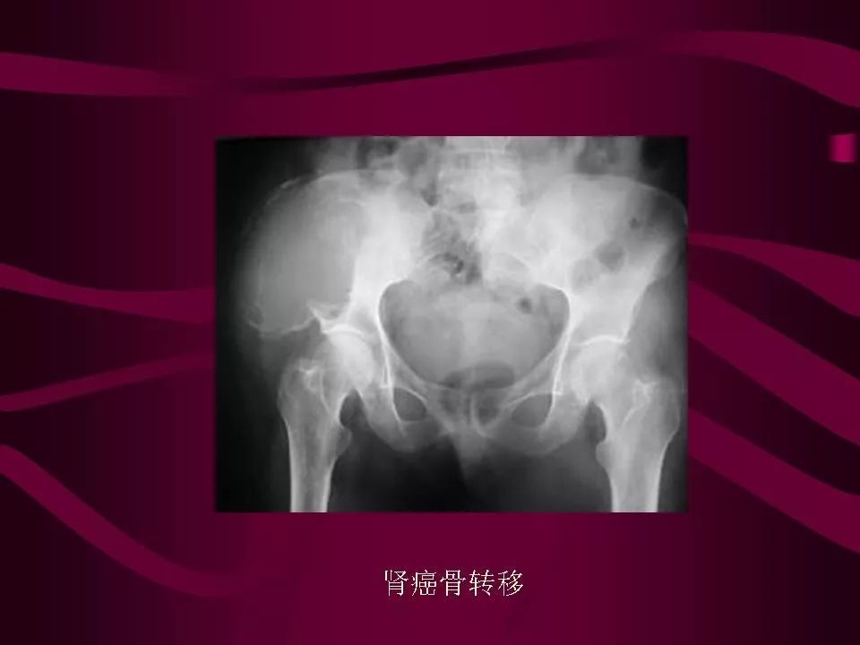 影像PPT - 【PPT】骨转移瘤的影像诊断-42