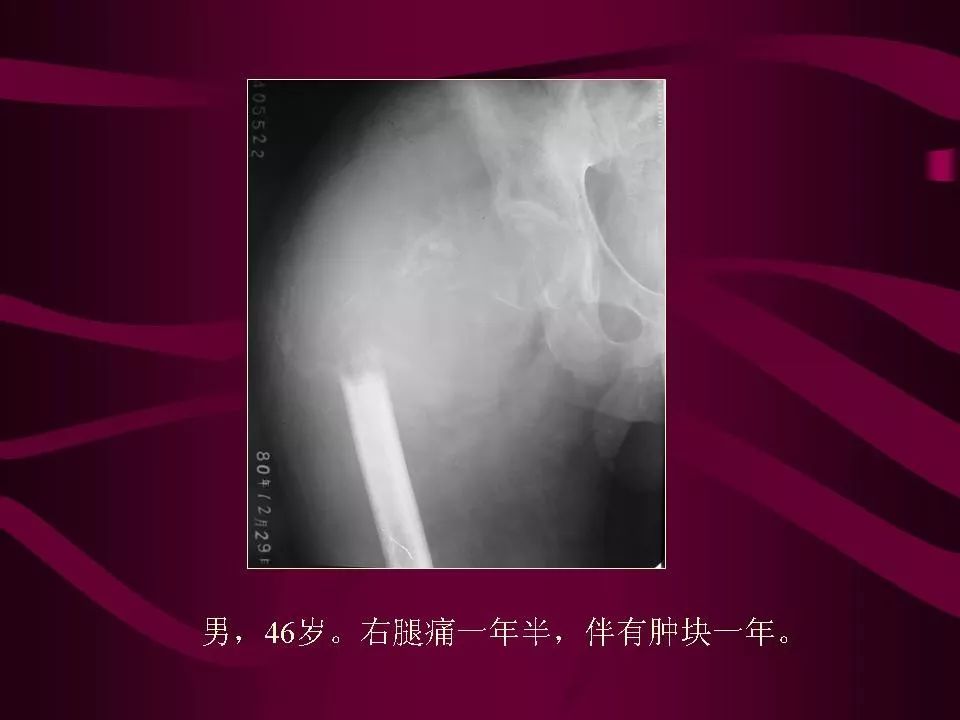 影像PPT - 【PPT】骨转移瘤的影像诊断-41