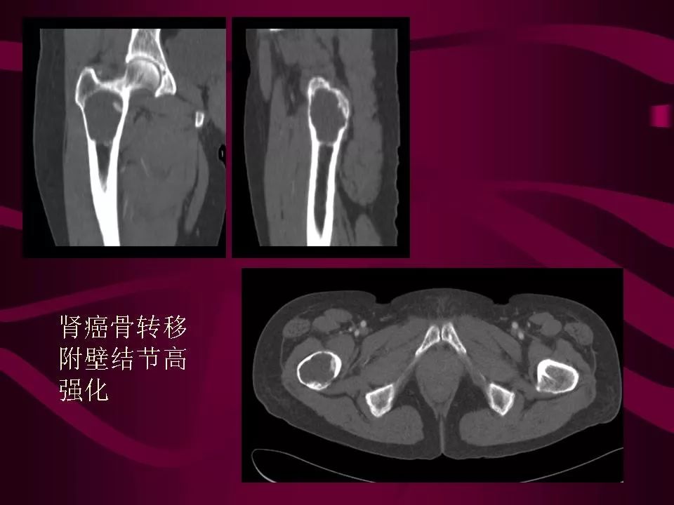 影像PPT - 【PPT】骨转移瘤的影像诊断-44