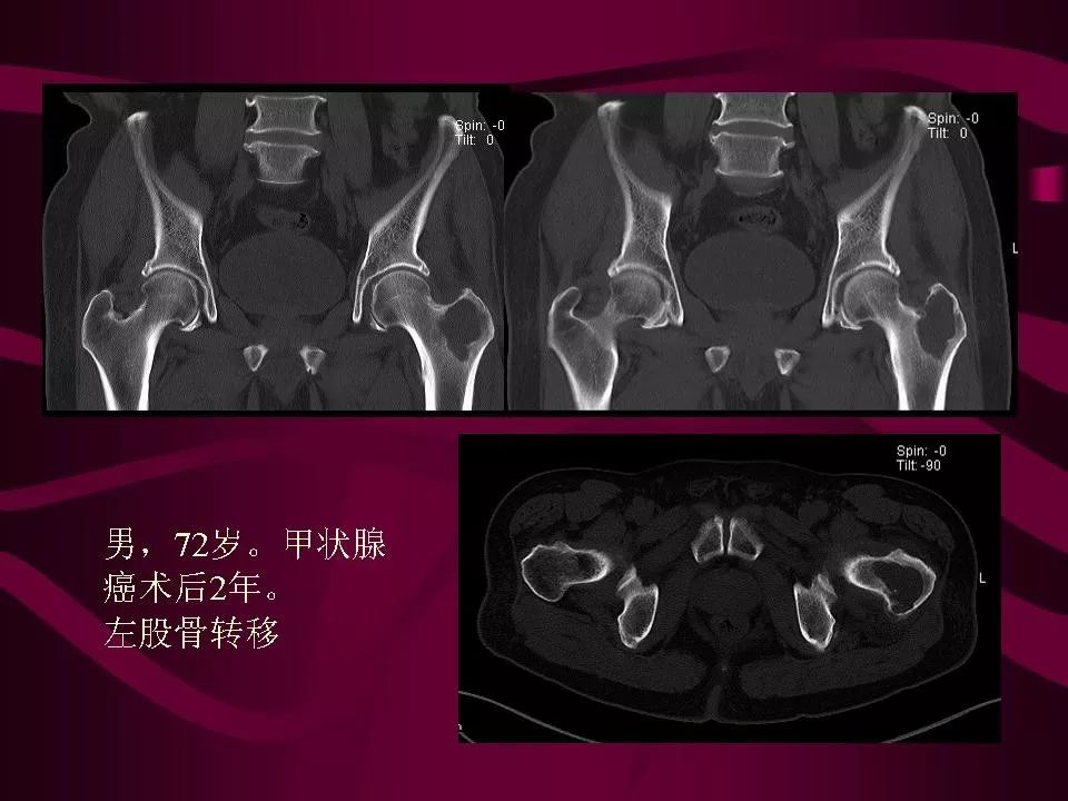 影像PPT - 【PPT】骨转移瘤的影像诊断-45