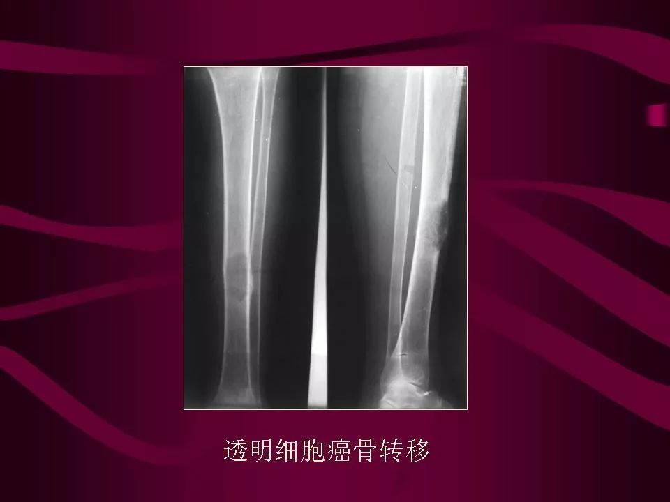 影像PPT - 【PPT】骨转移瘤的影像诊断-46
