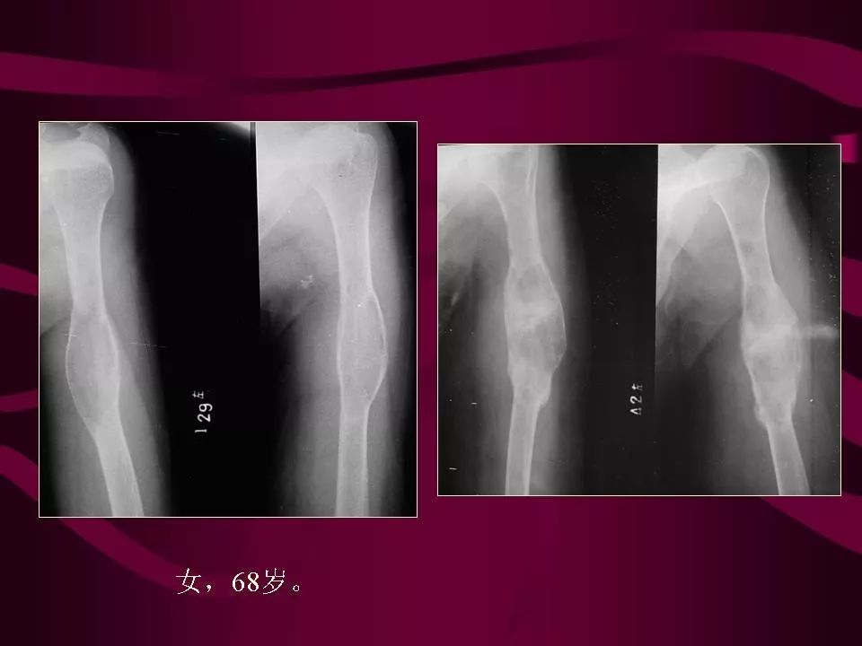 影像PPT - 【PPT】骨转移瘤的影像诊断-48