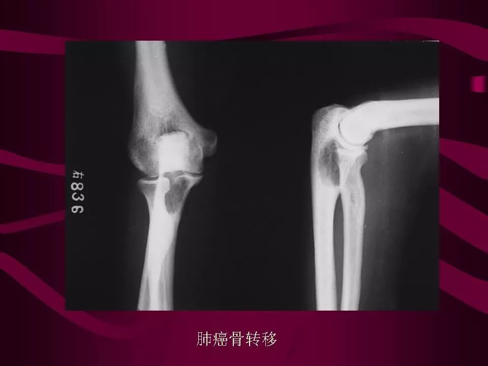 影像PPT - 【PPT】骨转移瘤的影像诊断-47