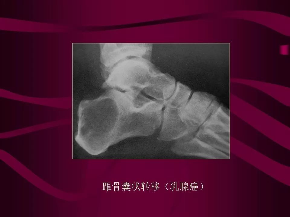 影像PPT - 【PPT】骨转移瘤的影像诊断-49