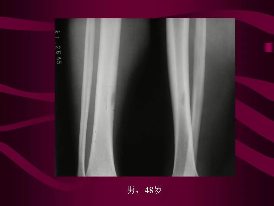 影像PPT - 【PPT】骨转移瘤的影像诊断-51