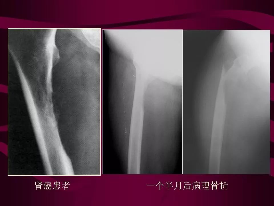 影像PPT - 【PPT】骨转移瘤的影像诊断-54