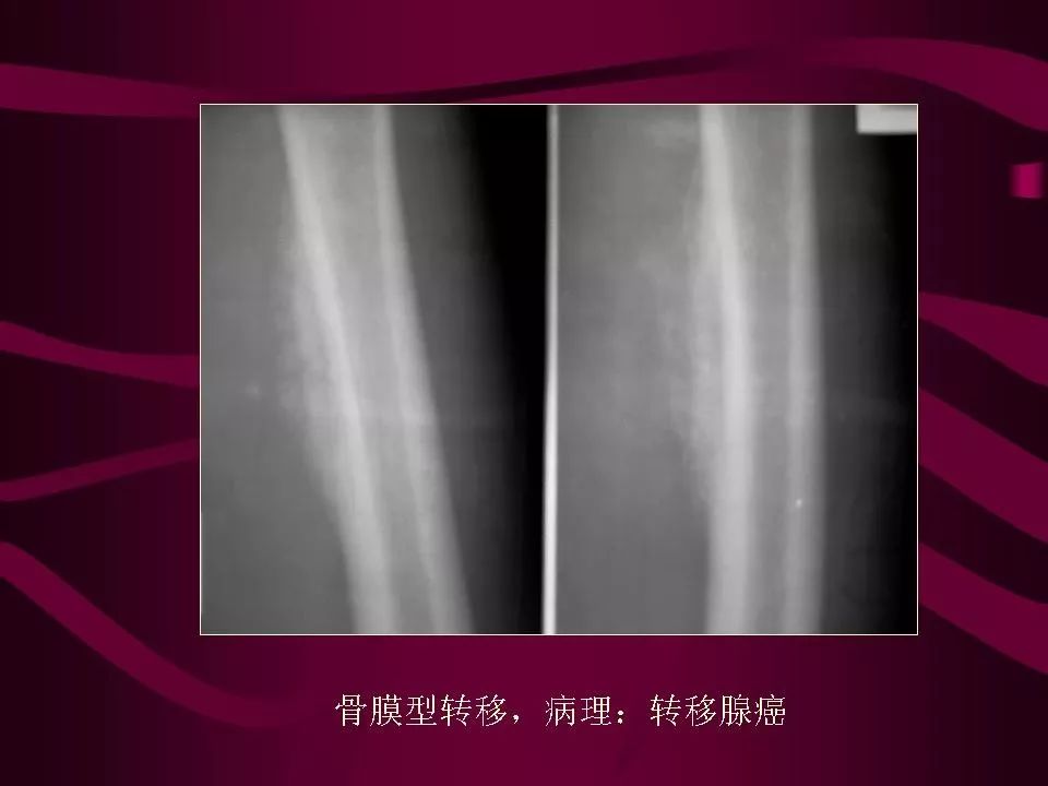 影像PPT - 【PPT】骨转移瘤的影像诊断-56