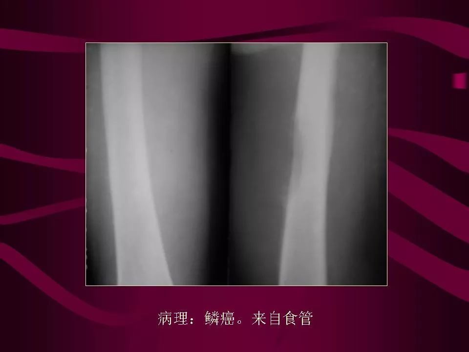 影像PPT - 【PPT】骨转移瘤的影像诊断-55