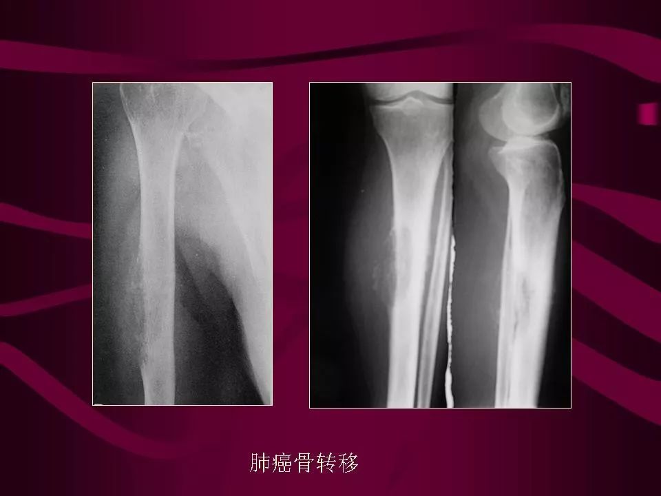 影像PPT - 【PPT】骨转移瘤的影像诊断-57