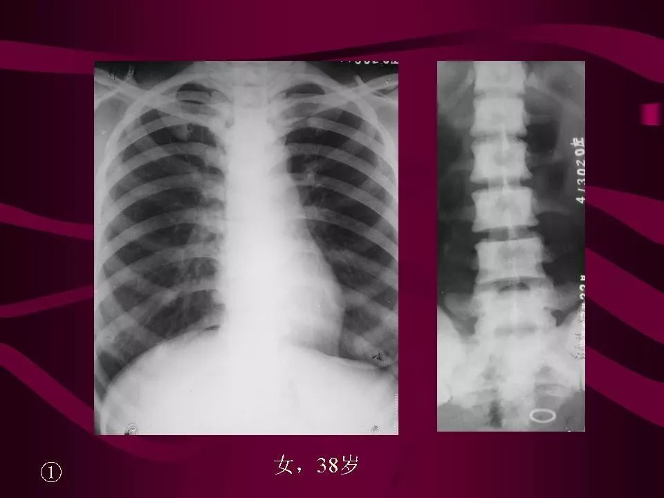 影像PPT - 【PPT】骨转移瘤的影像诊断-61