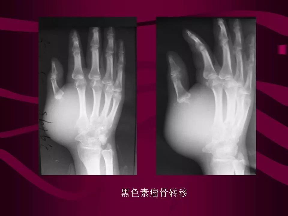 影像PPT - 【PPT】骨转移瘤的影像诊断-66