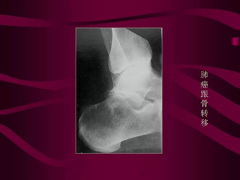 影像PPT - 【PPT】骨转移瘤的影像诊断-67