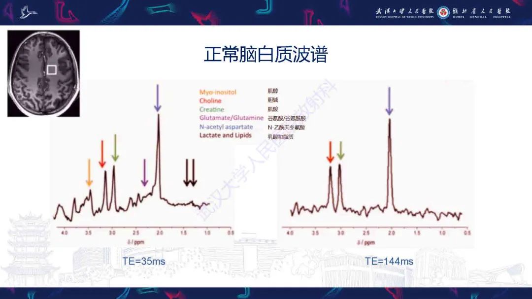 影像PPT - 【PPT】1H-MRS在中枢神经系统疾病中的应用-15