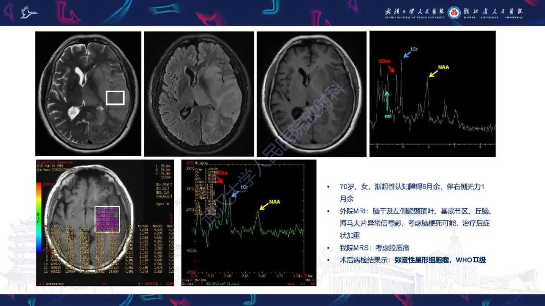 影像PPT - 【PPT】1H-MRS在中枢神经系统疾病中的应用-33