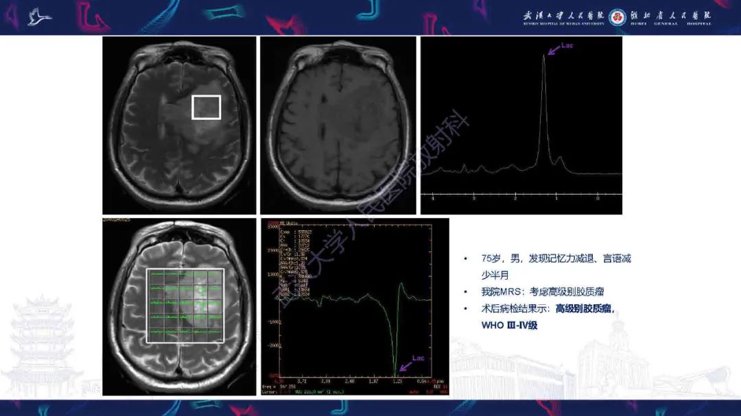 影像PPT - 【PPT】1H-MRS在中枢神经系统疾病中的应用-35