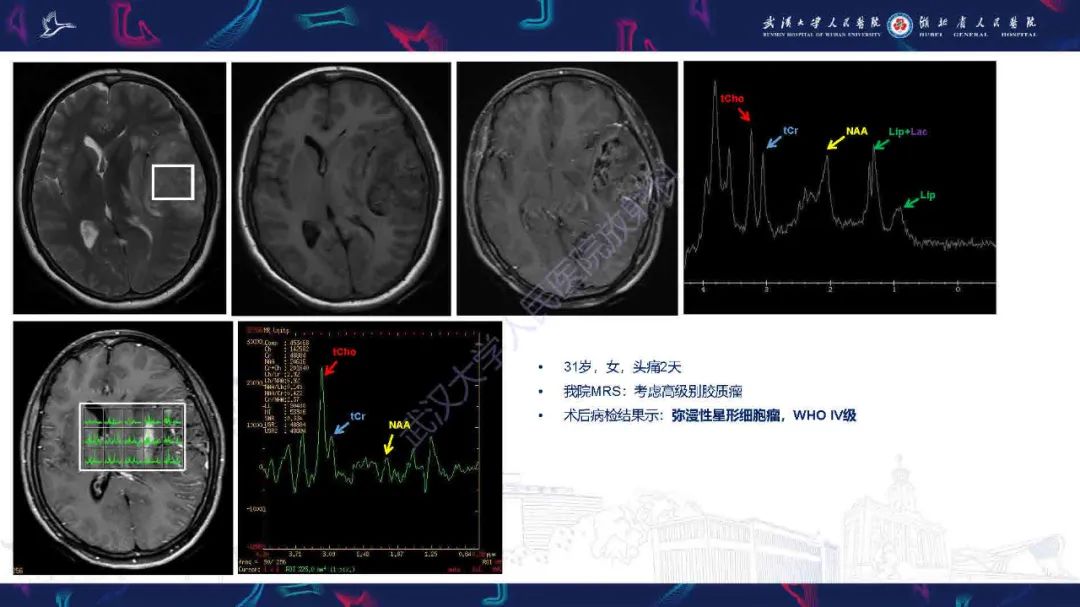 影像PPT - 【PPT】1H-MRS在中枢神经系统疾病中的应用-37