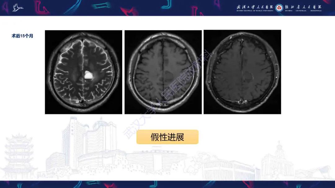 影像PPT - 【PPT】1H-MRS在中枢神经系统疾病中的应用-42