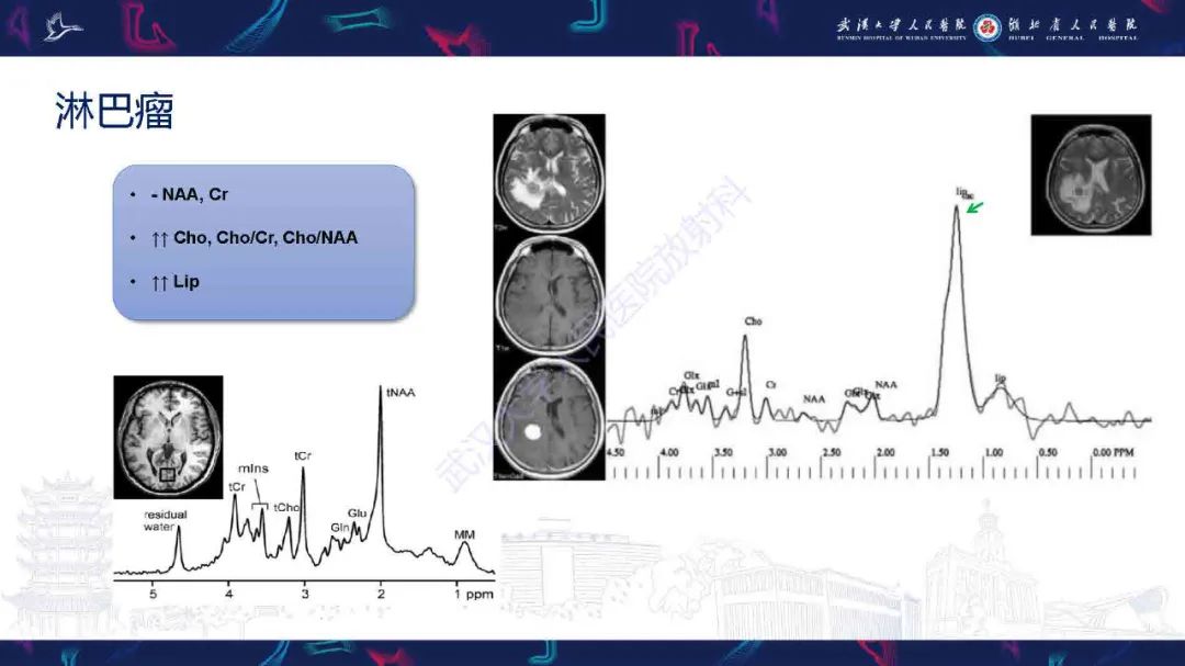 影像PPT - 【PPT】1H-MRS在中枢神经系统疾病中的应用-45
