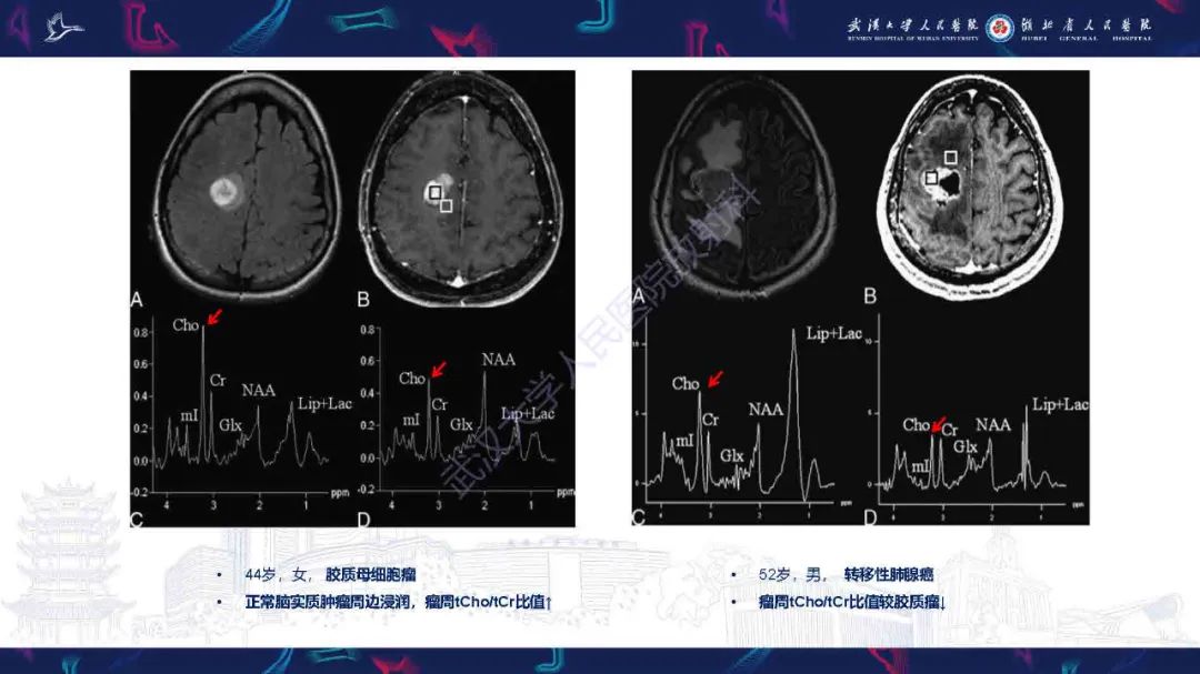 影像PPT - 【PPT】1H-MRS在中枢神经系统疾病中的应用-50