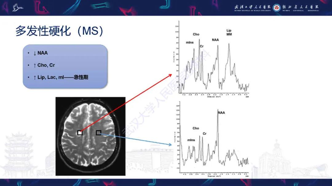 影像PPT - 【PPT】1H-MRS在中枢神经系统疾病中的应用-52
