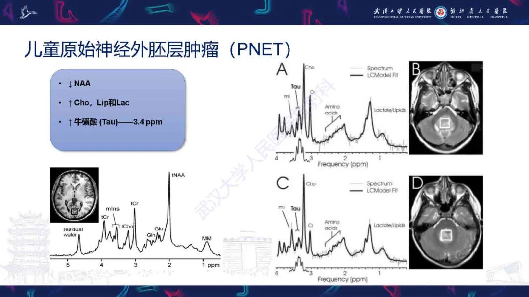 影像PPT - 【PPT】1H-MRS在中枢神经系统疾病中的应用-51