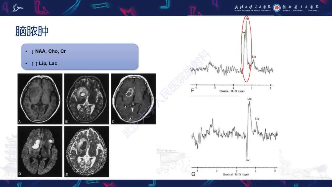 影像PPT - 【PPT】1H-MRS在中枢神经系统疾病中的应用-55