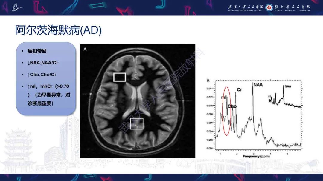 影像PPT - 【PPT】1H-MRS在中枢神经系统疾病中的应用-56