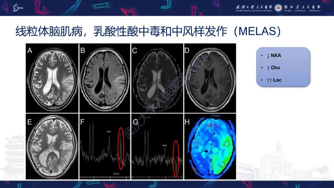 影像PPT - 【PPT】1H-MRS在中枢神经系统疾病中的应用-58
