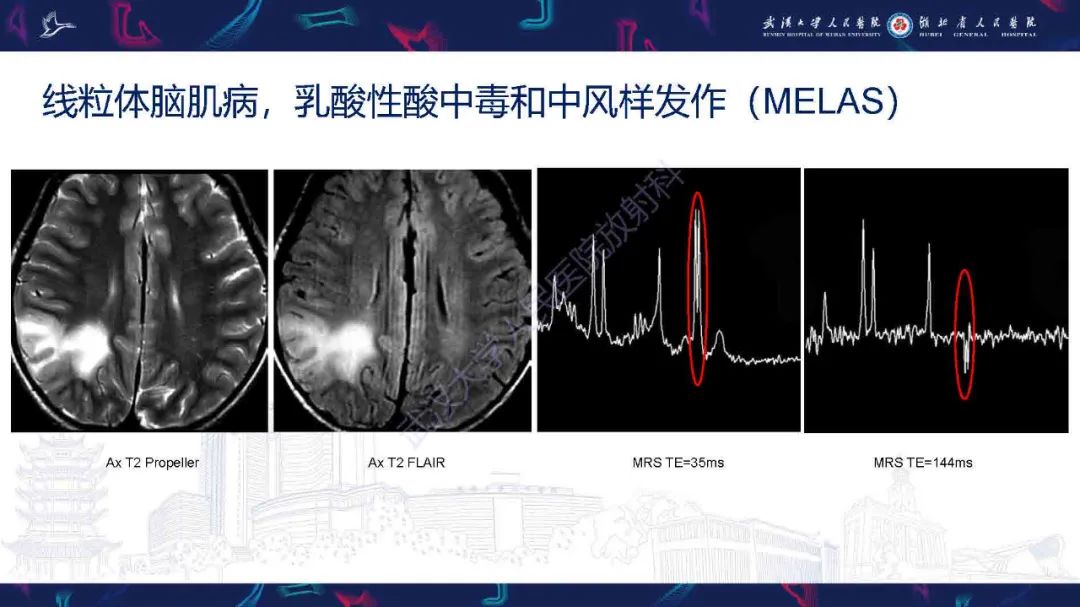 影像PPT - 【PPT】1H-MRS在中枢神经系统疾病中的应用-59