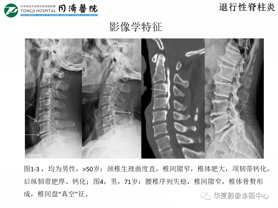 影像PPT - 【PPT】脊柱炎性病变的影像诊断思路-6