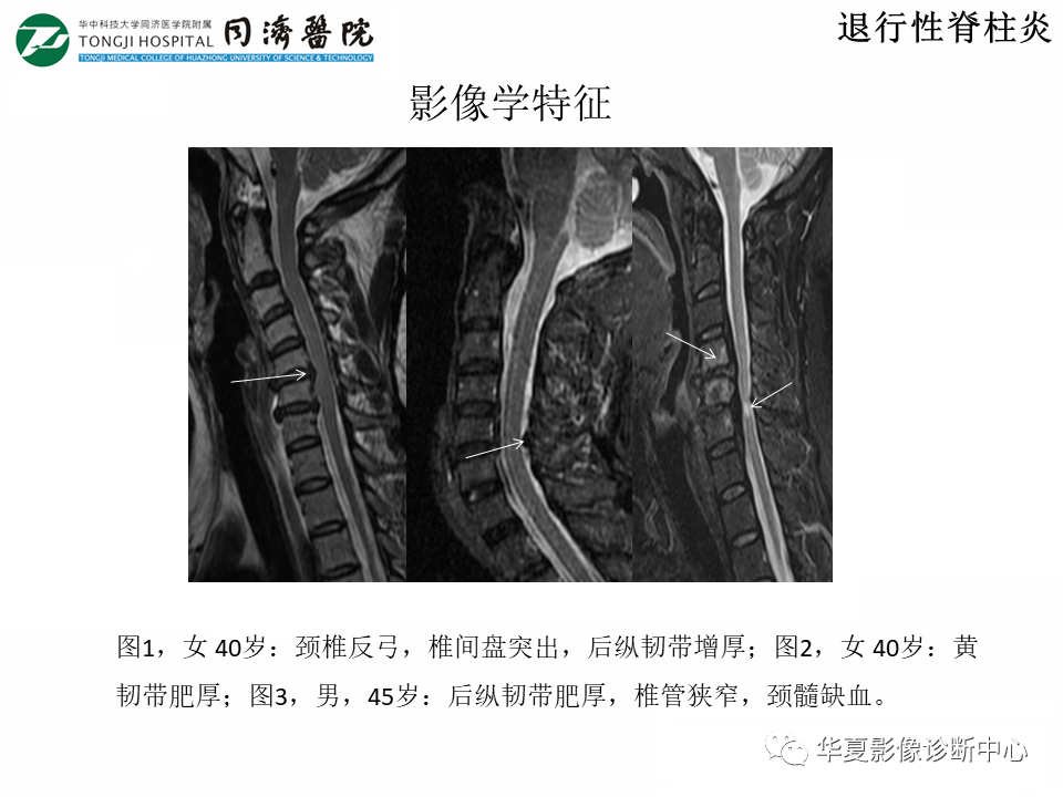 影像PPT - 【PPT】脊柱炎性病变的影像诊断思路-7