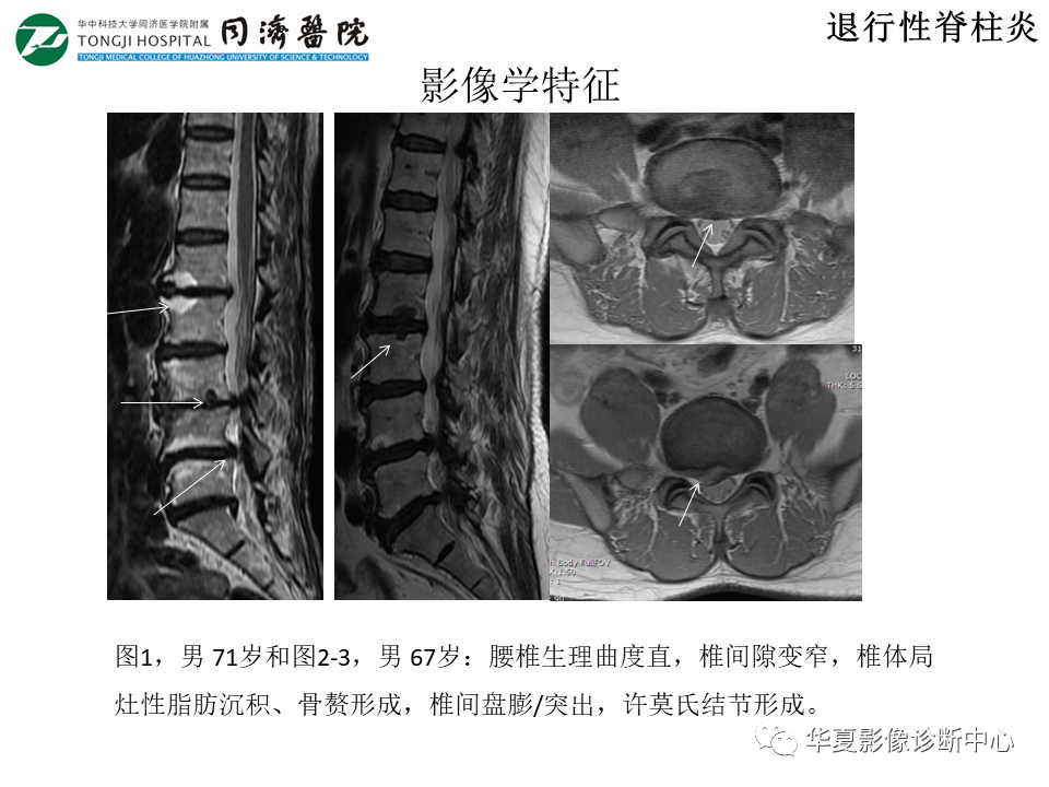 影像PPT - 【PPT】脊柱炎性病变的影像诊断思路-8