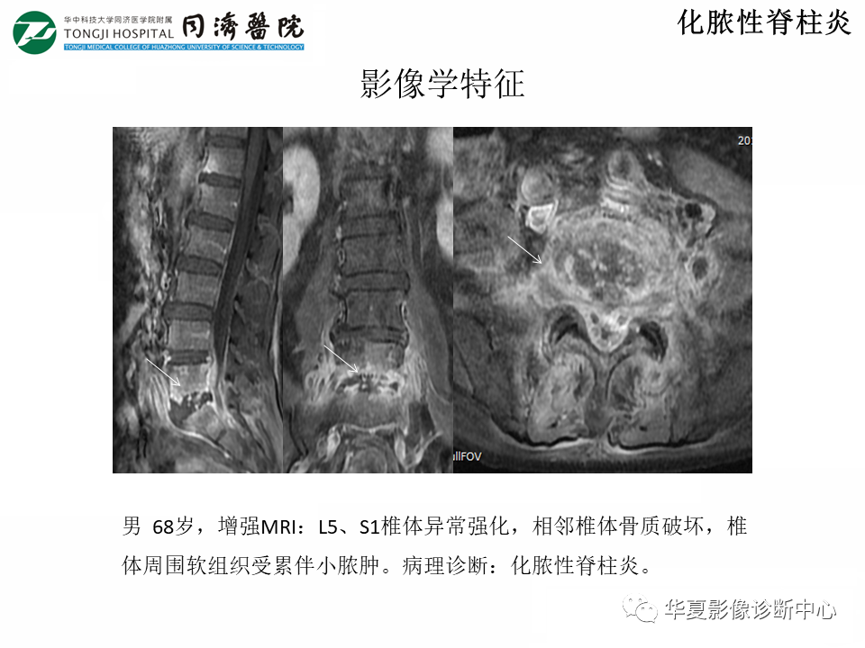 影像PPT - 【PPT】脊柱炎性病变的影像诊断思路-14