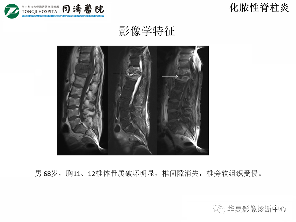 影像PPT - 【PPT】脊柱炎性病变的影像诊断思路-15