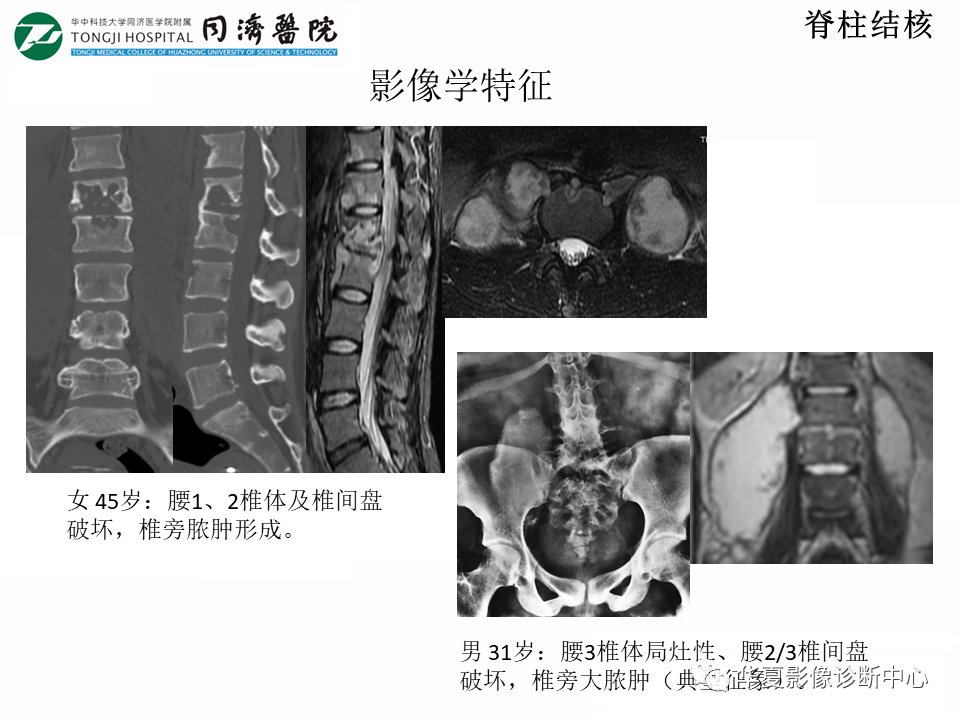 影像PPT - 【PPT】脊柱炎性病变的影像诊断思路-19