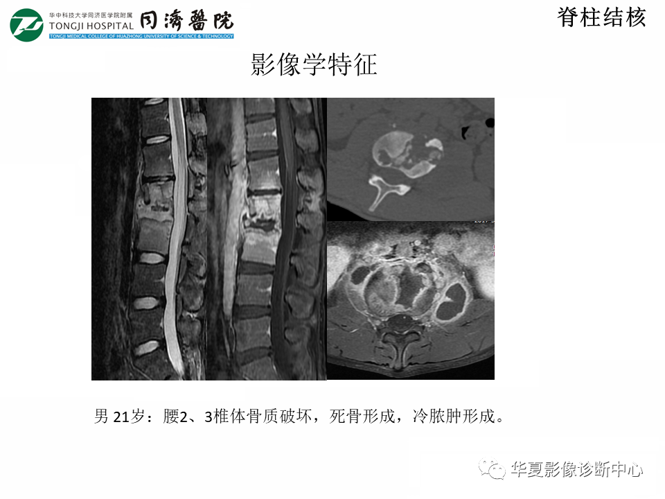 影像PPT - 【PPT】脊柱炎性病变的影像诊断思路-20