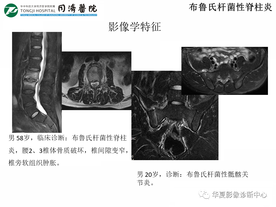 影像PPT - 【PPT】脊柱炎性病变的影像诊断思路-26
