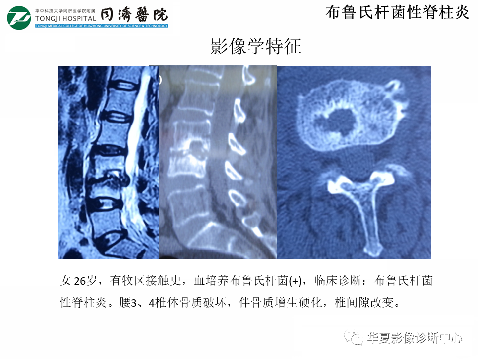 影像PPT - 【PPT】脊柱炎性病变的影像诊断思路-25
