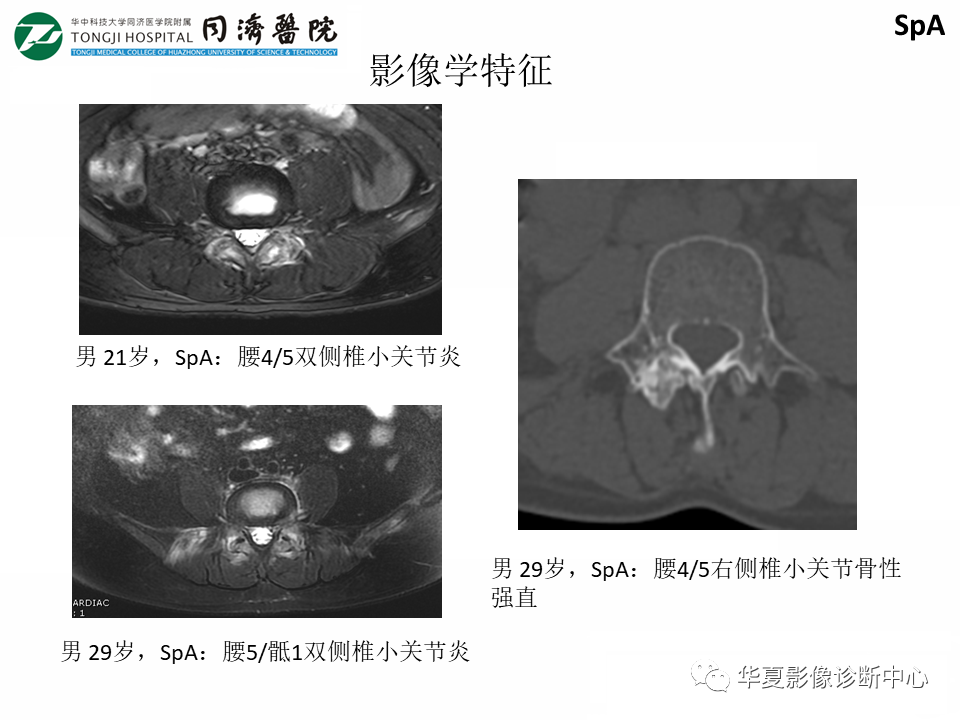 影像PPT - 【PPT】脊柱炎性病变的影像诊断思路-30