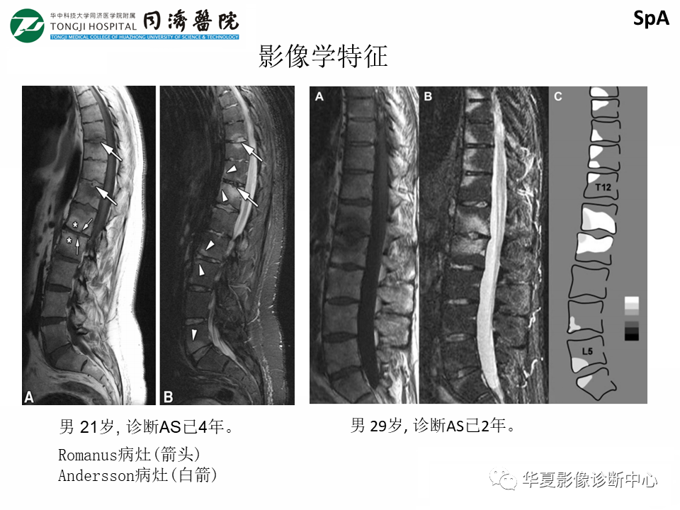 影像PPT - 【PPT】脊柱炎性病变的影像诊断思路-31