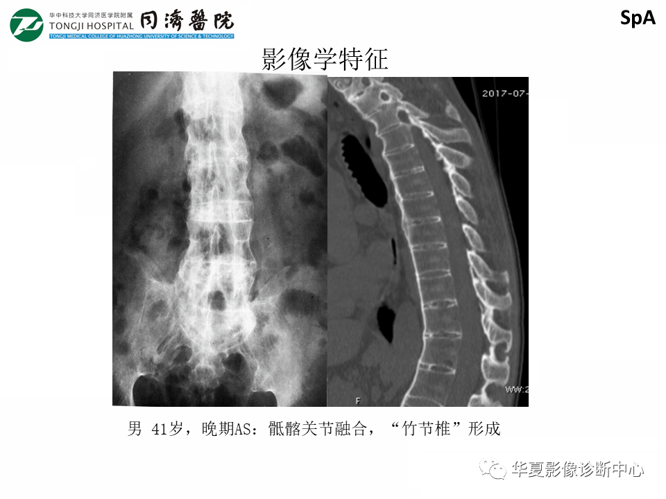 影像PPT - 【PPT】脊柱炎性病变的影像诊断思路-32