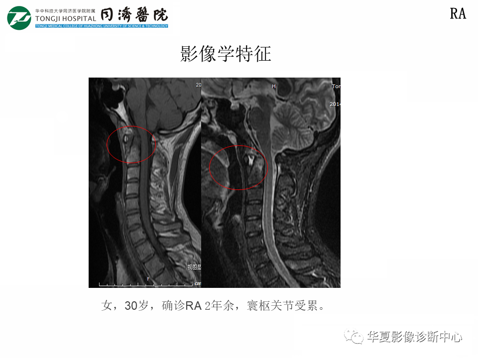影像PPT - 【PPT】脊柱炎性病变的影像诊断思路-34