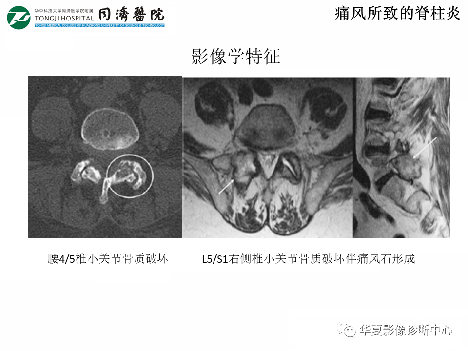 影像PPT - 【PPT】脊柱炎性病变的影像诊断思路-37