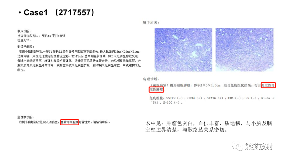 影像PPT - 【病例】颅内孤立性纤维性肿瘤2例CT及MR影像-12