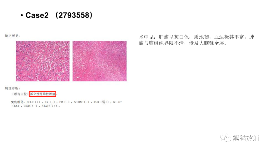 影像PPT - 【病例】颅内孤立性纤维性肿瘤2例CT及MR影像-14