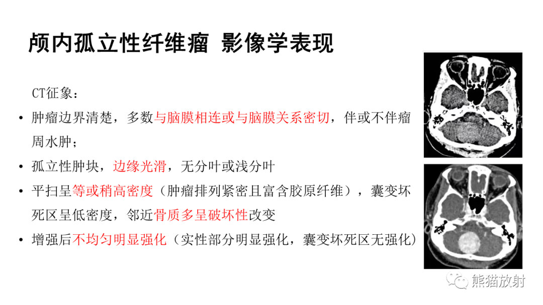 影像PPT - 【病例】颅内孤立性纤维性肿瘤2例CT及MR影像-20