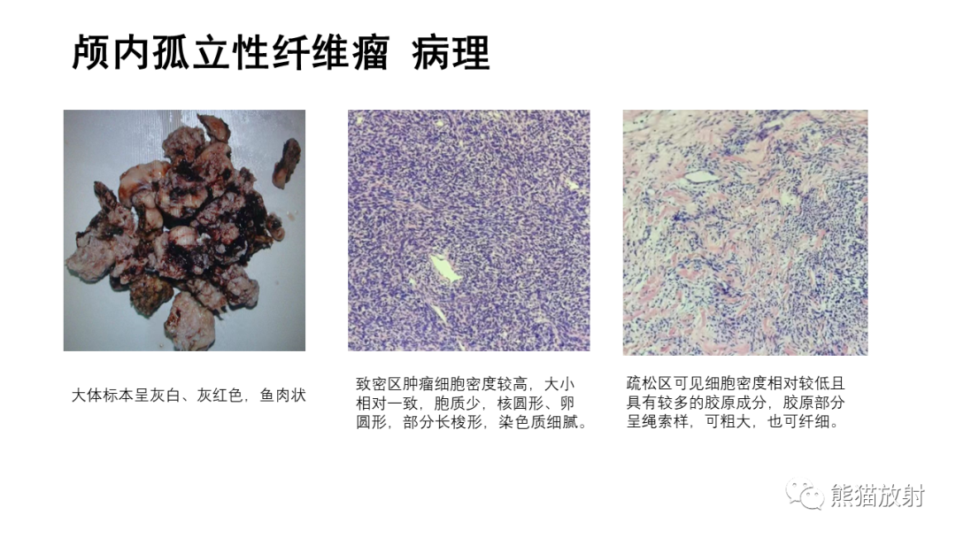 影像PPT - 【病例】颅内孤立性纤维性肿瘤2例CT及MR影像-18